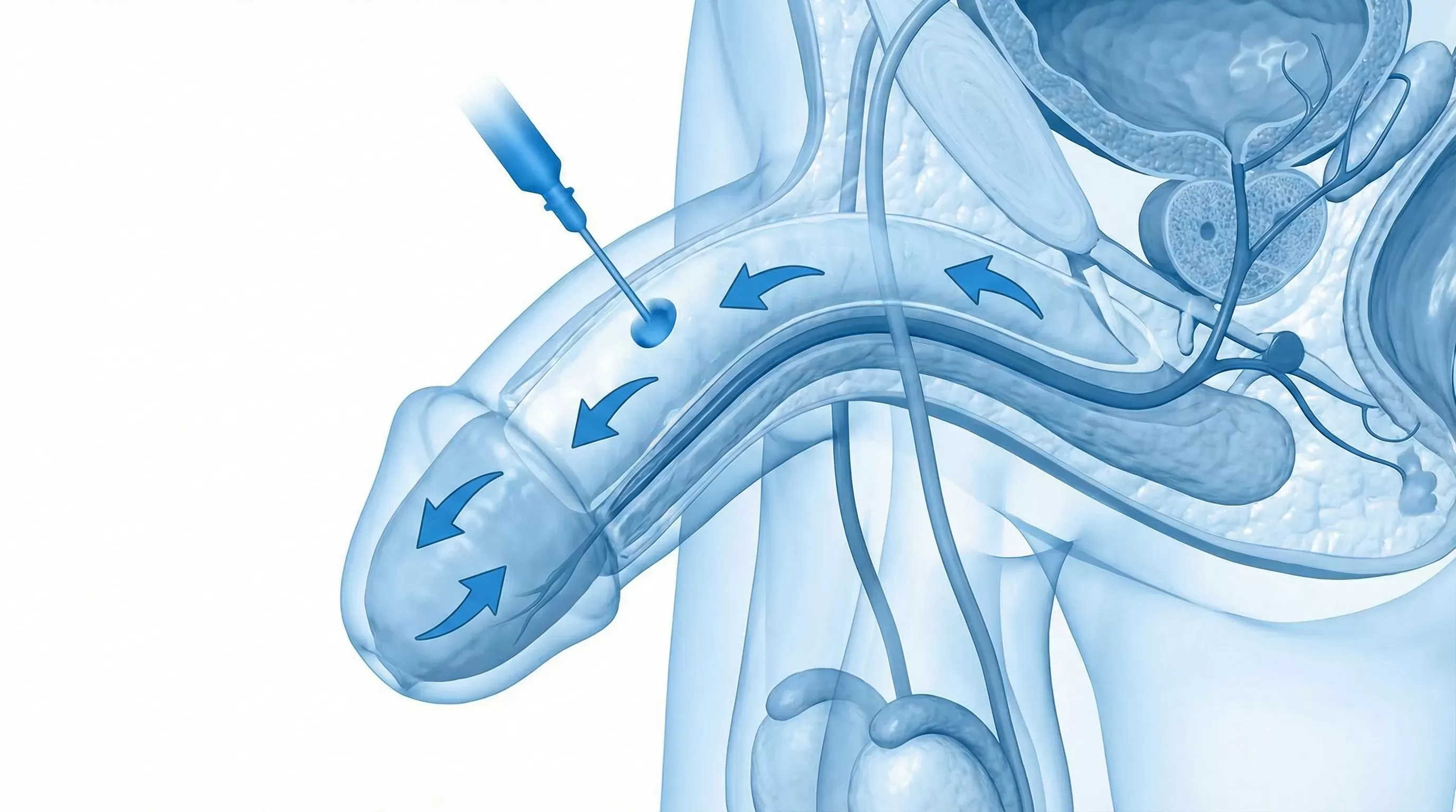 ** Damat Dolgusu Nedir? İzmir Penis Kalınlaştırma ve Fiya...